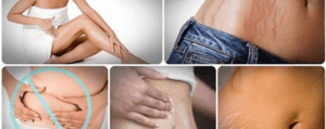 Estrías: causas, tratamientos y cómo prevenir su aparición de forma natural