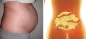 elicobacter pylori y estómago hinchado: síntomas y tratamiento