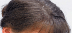 Remedios caseros para la caspa: cómo eliminarla de forma natural y cuidar tu cabello