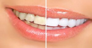Cómo tener dientes blancos de forma natural: consejos seguros y remedios eficaces