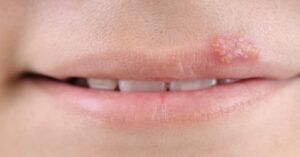 Herpes labial: causas, síntomas, tratamientos y remedios naturales que funcionan