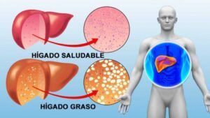 Cómo limpiar el hígado de forma natural: alimentos y hábitos para cuidar tu salud hepática