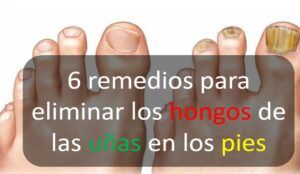 6 remedios para eliminar los hongos de las uñas en los pies