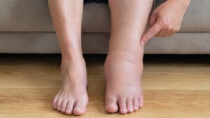 Pies hinchados por edema con inflamación visible en los tobillos debido a la acumulación de líquidos.